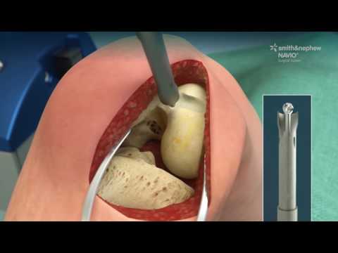 Animated overview of NAVIO Surgical System