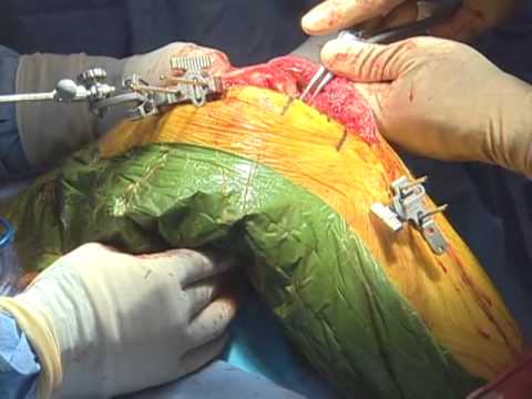 Computer-assisted Total Knee Replacement
