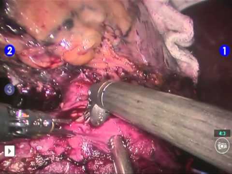 Inferior Vena Cava (IVC) Thrombectomy – da Vinci Robotic Surgery