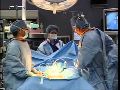 Live robotic hysterectomy surgery