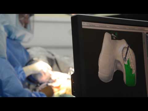 MAKOplasty: Robotic-Assisted Surgery for Partial Knee Replacement
