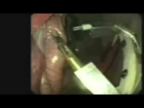 Mini Surgical Robots