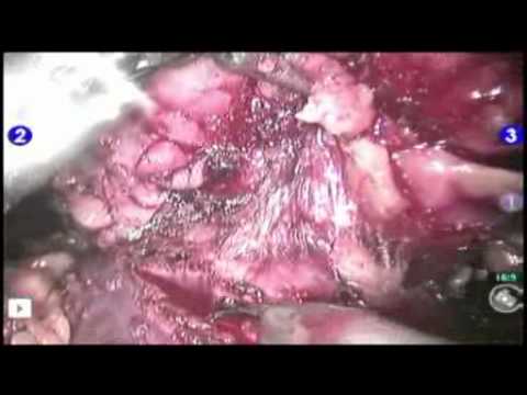 Newest Surgical Option for Kidney Cancer