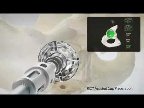 Orthopedics: Robotic-Assisted Hip Replacement
