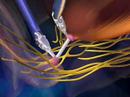 Prostate Cancer: daVinci Robotic Prostatectomy