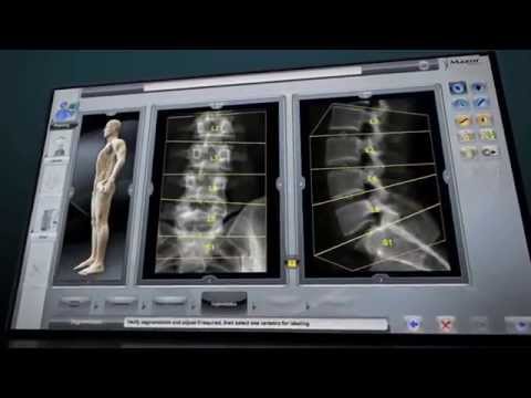 Renaissance Spine Surgery – How it Works