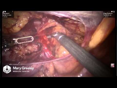 Robot-Assisted Hernia Repair (Full Length Surgery)