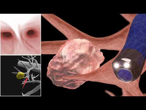 Robotic bronchoscopy – Mayo Clinic