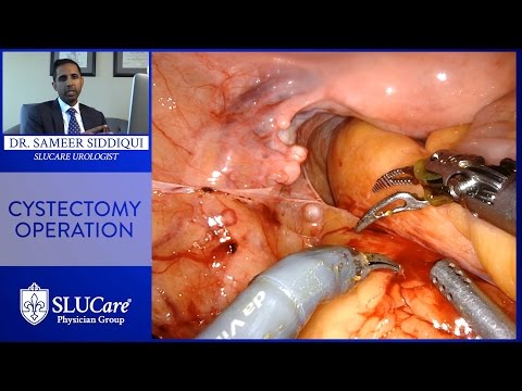 Robotic Cystectomy Procedure To Remove Bladder  – SLUCare Urology