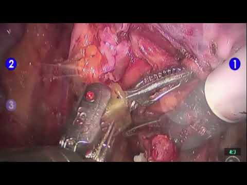 Robotic Female Radical Cystectomy Procedure | Brigham and Women's Hospital