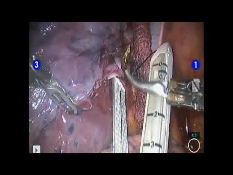 Robotic Lobectomy | Brigham and Women's Hospital
