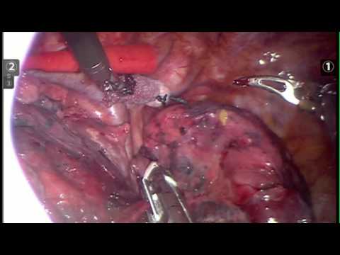Robotic Lobectomy Lung Surgery performed by Surgeon Albert DiMeo St. Vincent's.mov