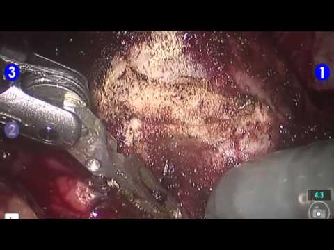 Robotic Prostatectomy Surgery