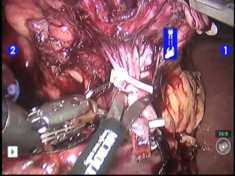 Robotic Radical Nephrectomy for Kidney Cancer: Technique and Results