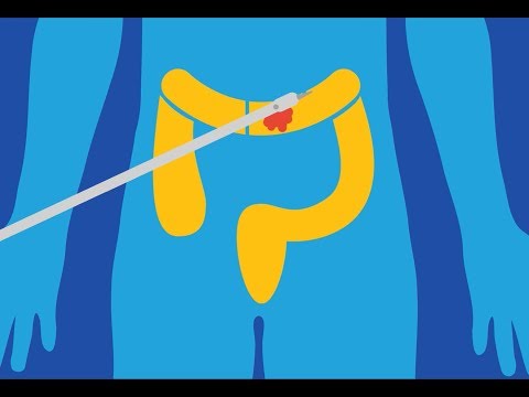 Robotic surgery for colon resection