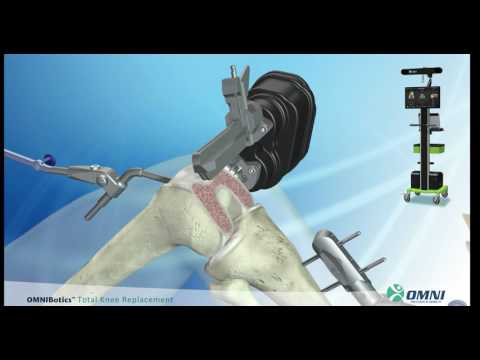 Robotically Assisted Knee Replacement – Ask the Doctor Series