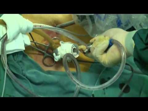 Robots used to complete surgery in C China