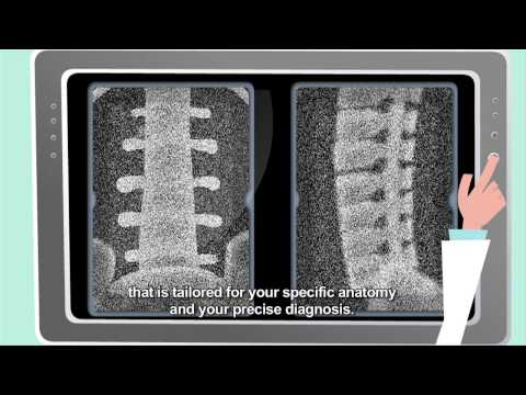 Spine Surgery with Mazor Robotics Renaissance