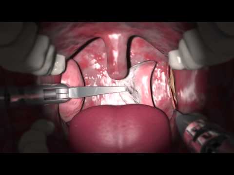 UCLA Advances Robotic Surgery Technique to Treat Cancer Tumors